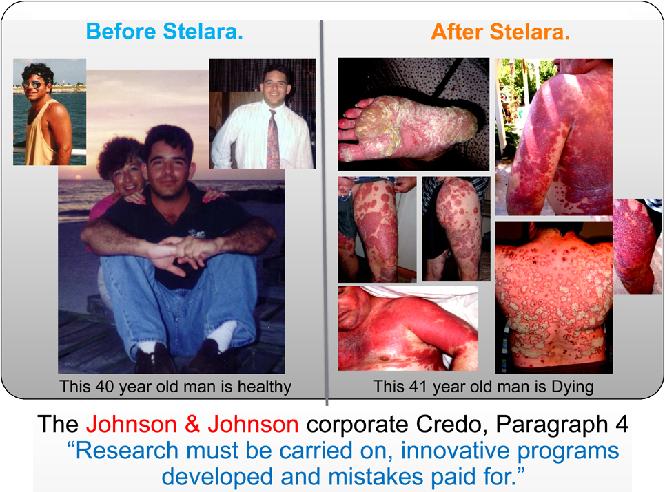 Stelara-Side-Effects, Ustekinumab, Psoriasis, Psoriatic Arthritis,